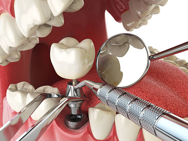 Best Broken or Chipped Tooth Repair in Fairmead, CA